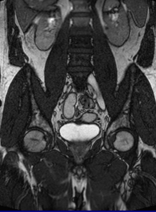 MRI testis localizer images mrimaster.ru